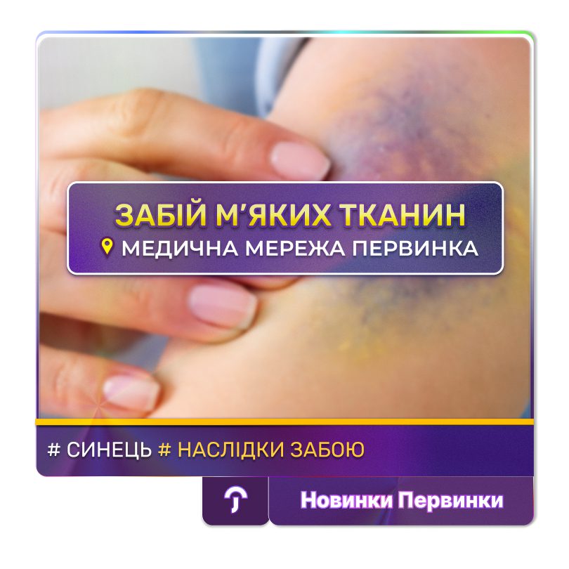 Обкладинка медичної мережі "Первинка". Після удару: коли синець варто показати лікарю, напрямок травматологія у МЦ "Первинка." Провідиний лікар травматолог Чумак Олег Борисович — травматолог, місто Кривий Ріг на 173 кварталі в МЦ "Первинка".