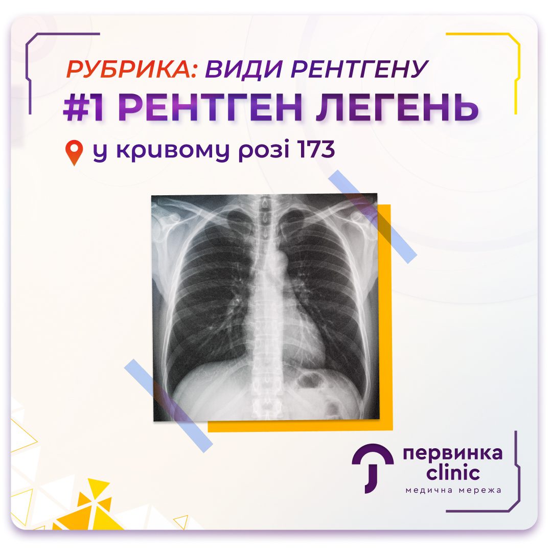 Рентгенівський знімок легень — рубрика «Види рентгену» в медичній мережі «Первинка», Кривий Ріг, 173 квартал