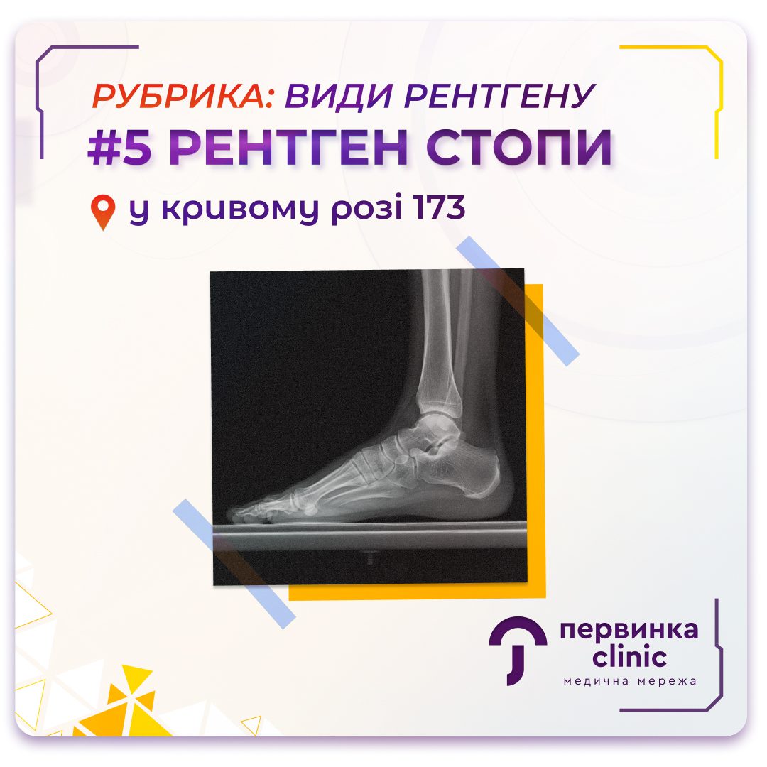 Обкладинка медичної мережі "Первинка". Рубрика види рентгену. №5 Рентген стопи. Цифровий рентген апарат у Кривому Розі на 173 кварталі. Рентгенографія у "Первинці"