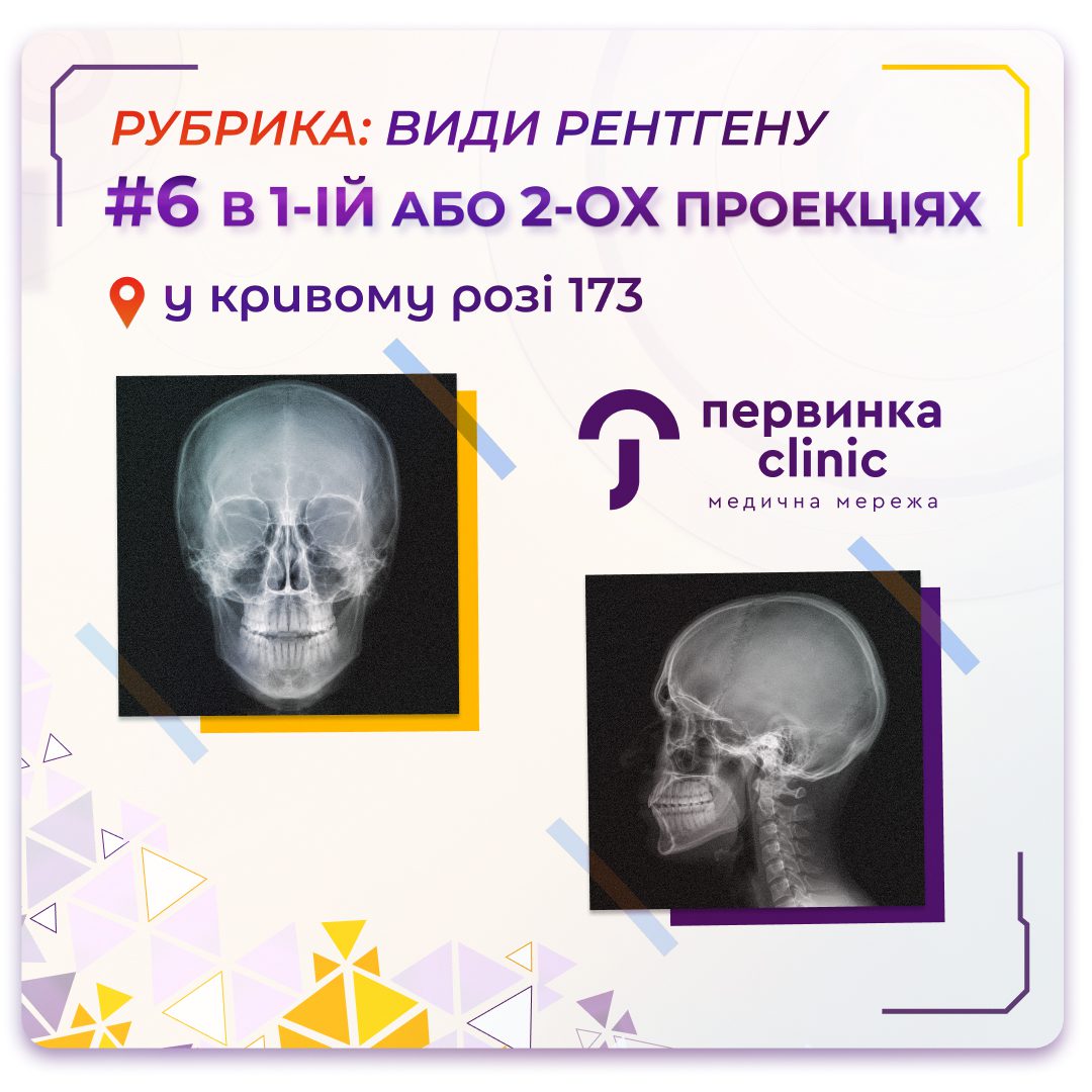 Обкладинка медичної мережі "Первинка". Рубрика: види рентгену #6. Кількість проекцій, для чого потрібно дві проекції?. Рентген у Кривому Розі на 173 кварталі, сучасний цифровий апарат
